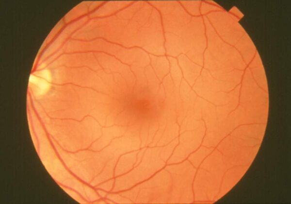 Salud: una herramienta de inteligencia artificial ya se utiliza en hospitales bonaerenses para detectar daños en la retina retina humana 600x420